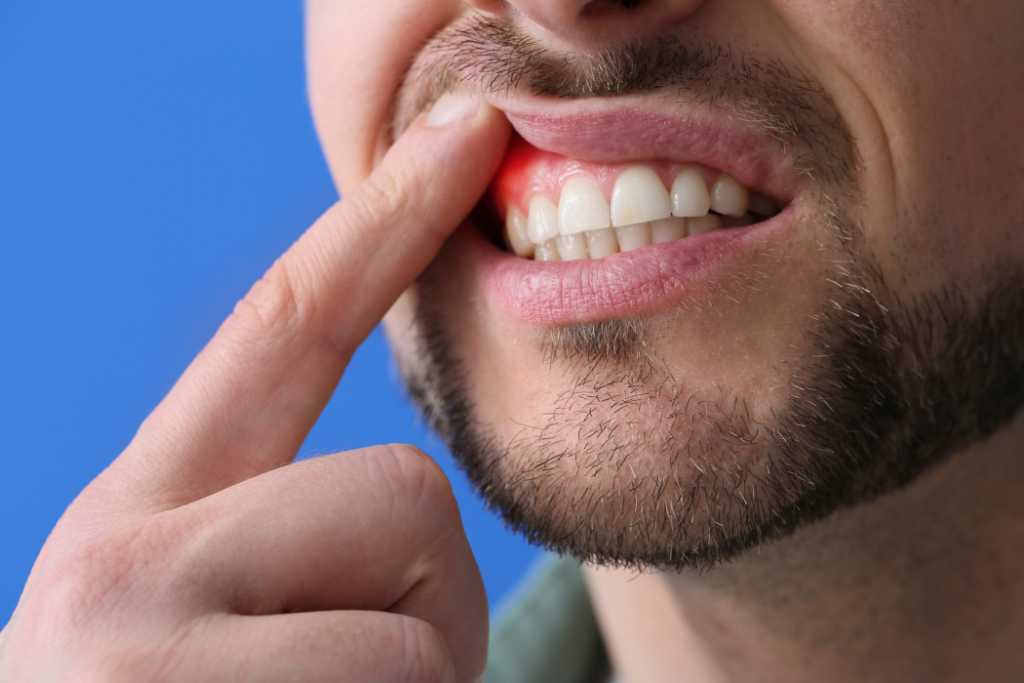 Qué es un absceso dental, síntomas, causas y tratamiento