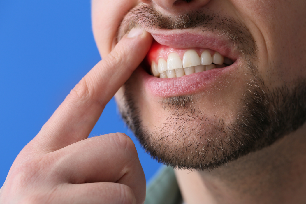 Qué es un absceso dental, síntomas, causas y tratamiento