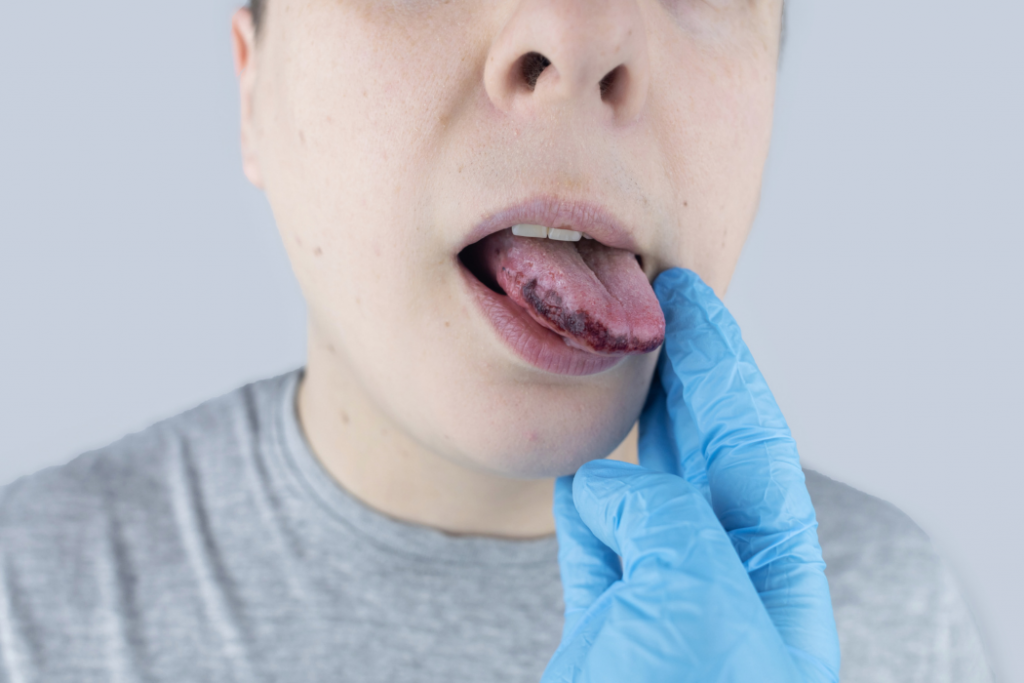 Xerostomía, el síndrome de la boca seca
