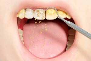 ¿Es cierto que la periodontitis se asocia con otras enfermedades