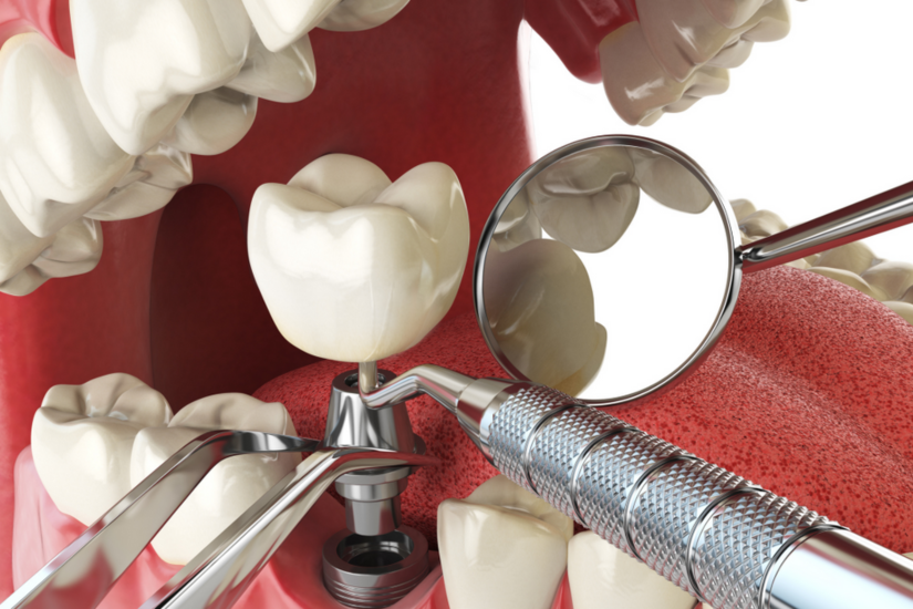 Todo lo que debes saber sobre implantes dentales