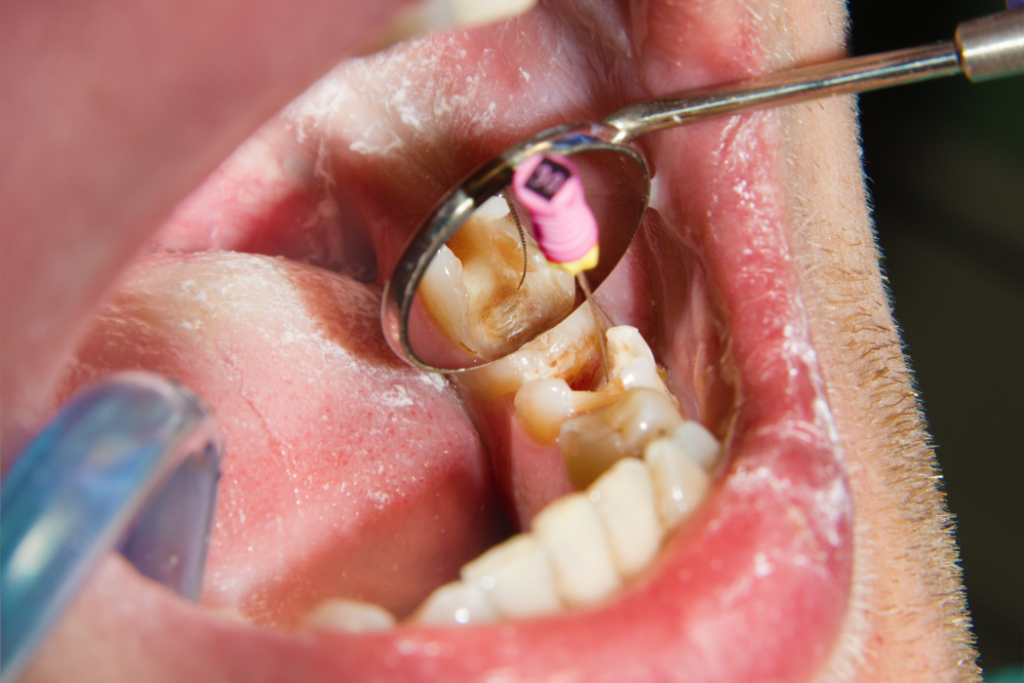 Endodoncia, qué es y cuanto dura