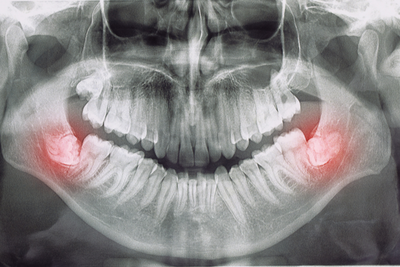 Muelas del juicio, es necesaria su extracción