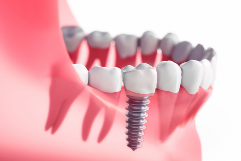 Cuál es el proceso de colocación de un implante dental