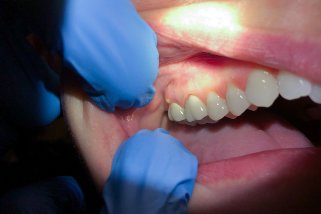 Absceso dental, causas y tratamiento
