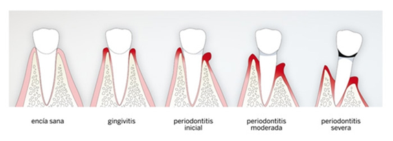 Periodontitis