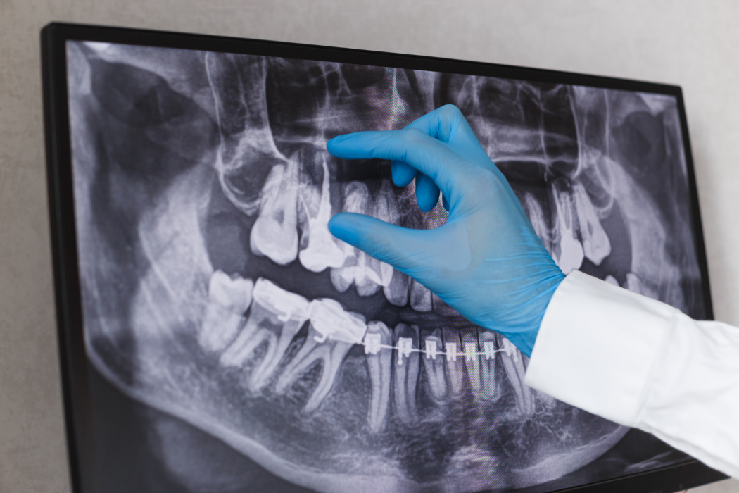 Control radiográfico en el diagnóstico de caries