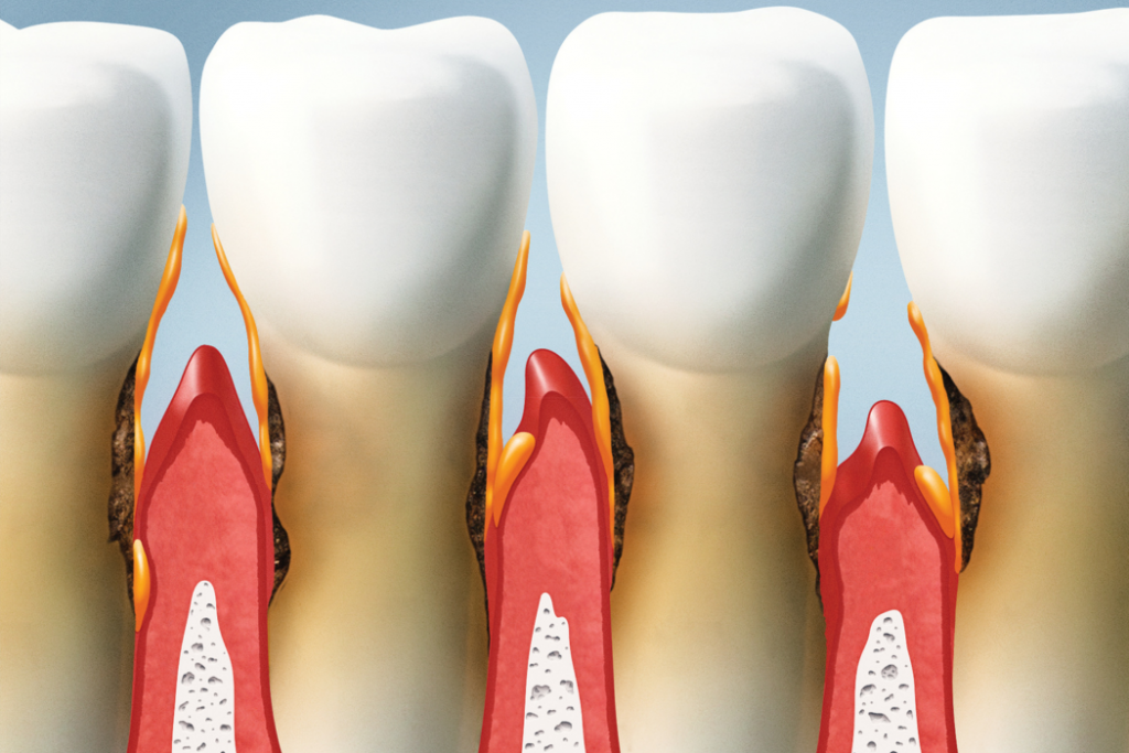 Qué es la periodoncia