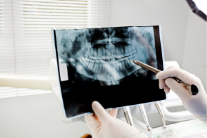 La importancia de un buen control raiográfico en el diagnóstico de caries