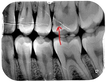 caries en radiografia