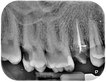 radiografia caries