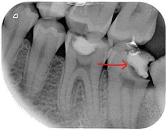 radiografia dental caries