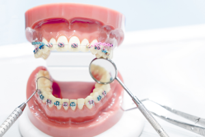 Cuáles son los beneficios de la ortodoncia