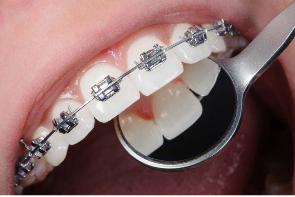 Tipos de tratamientos de ortodoncia