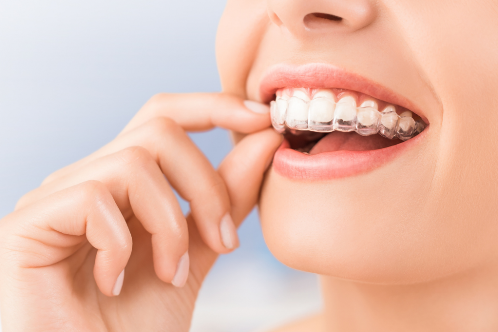 Cuánto dura el tratamiento de ortodoncia invisible