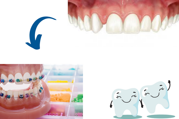 ¿Qué es la agenesia dental? Causas y tratamientos