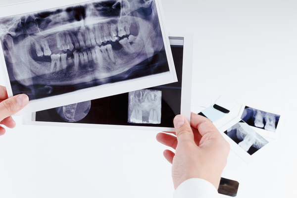 Control radiográfico y caries: Detección Precoz en Odontología