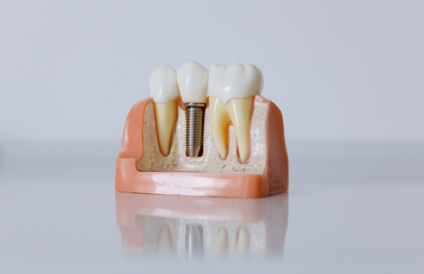 implantes dentales