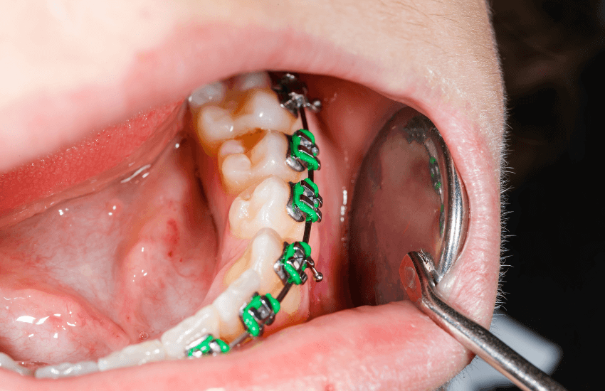 Sintomas de la infeccion dental ¿Cuando se necesita una endodoncia