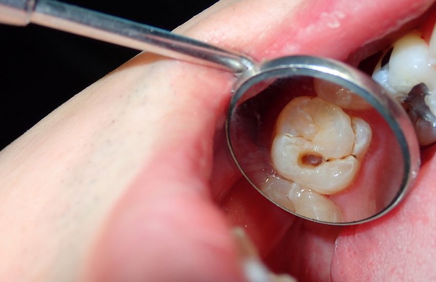 Importancia de la detección precoz de las caries dentales