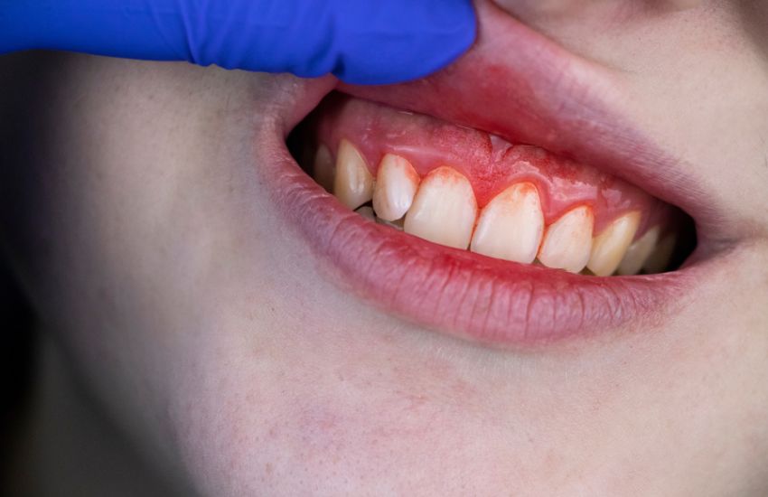 ¿Qué es la periodontitis?