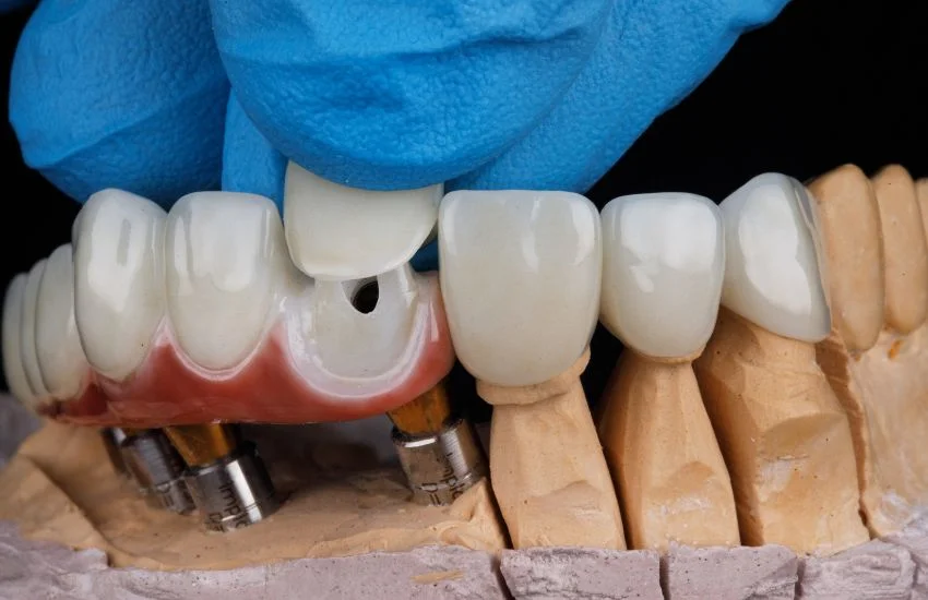 Diseño y fabricación de una incrustación Coronas dentales en la era digital