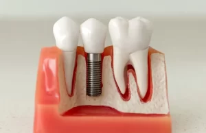 implante dental