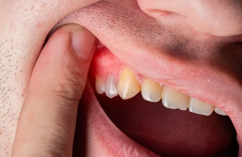 Recesiones gingivales