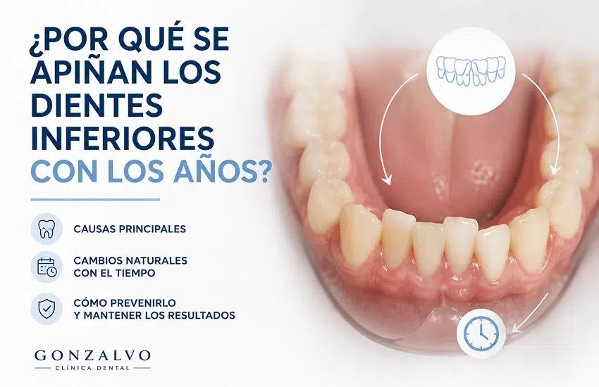 Revisión dental de dientes inferiores apiñados para valorar cambios de alineación con los años.